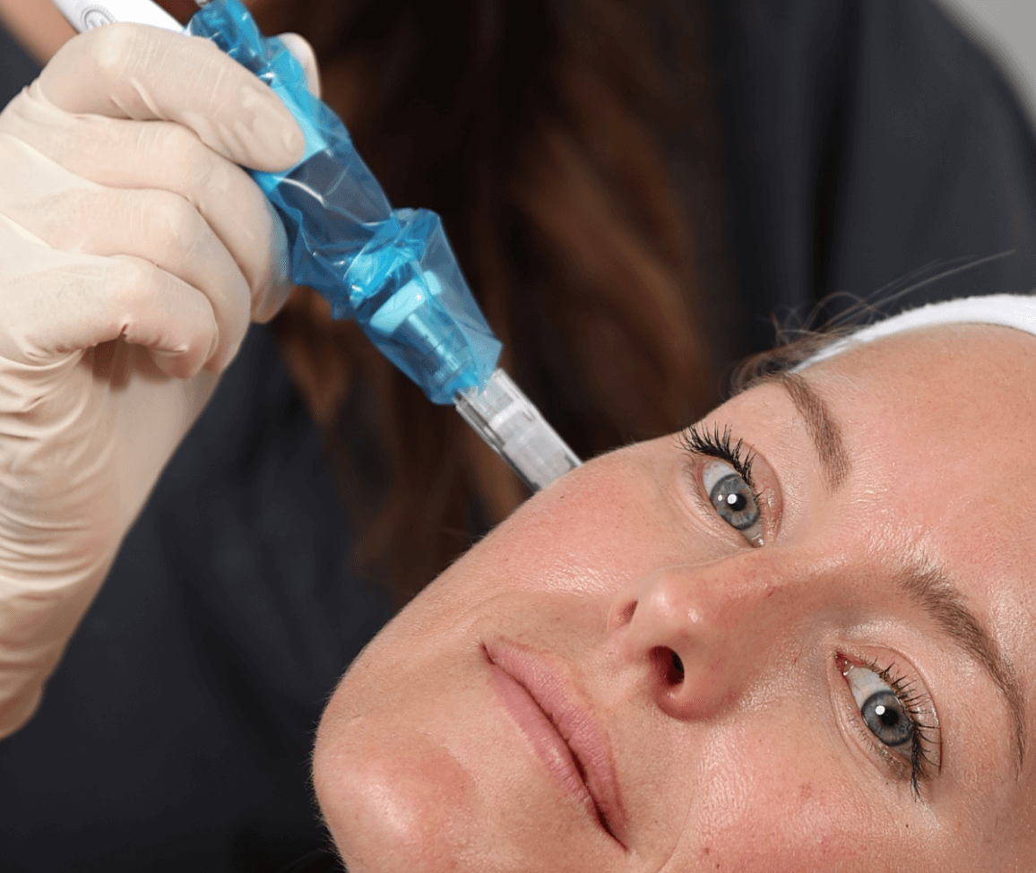microneedling leeds